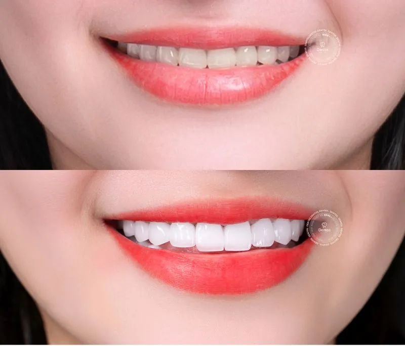 Răng sứ HT Smile có tốt không? Giá răng sứ HT Smile bao nhiêu tiền?